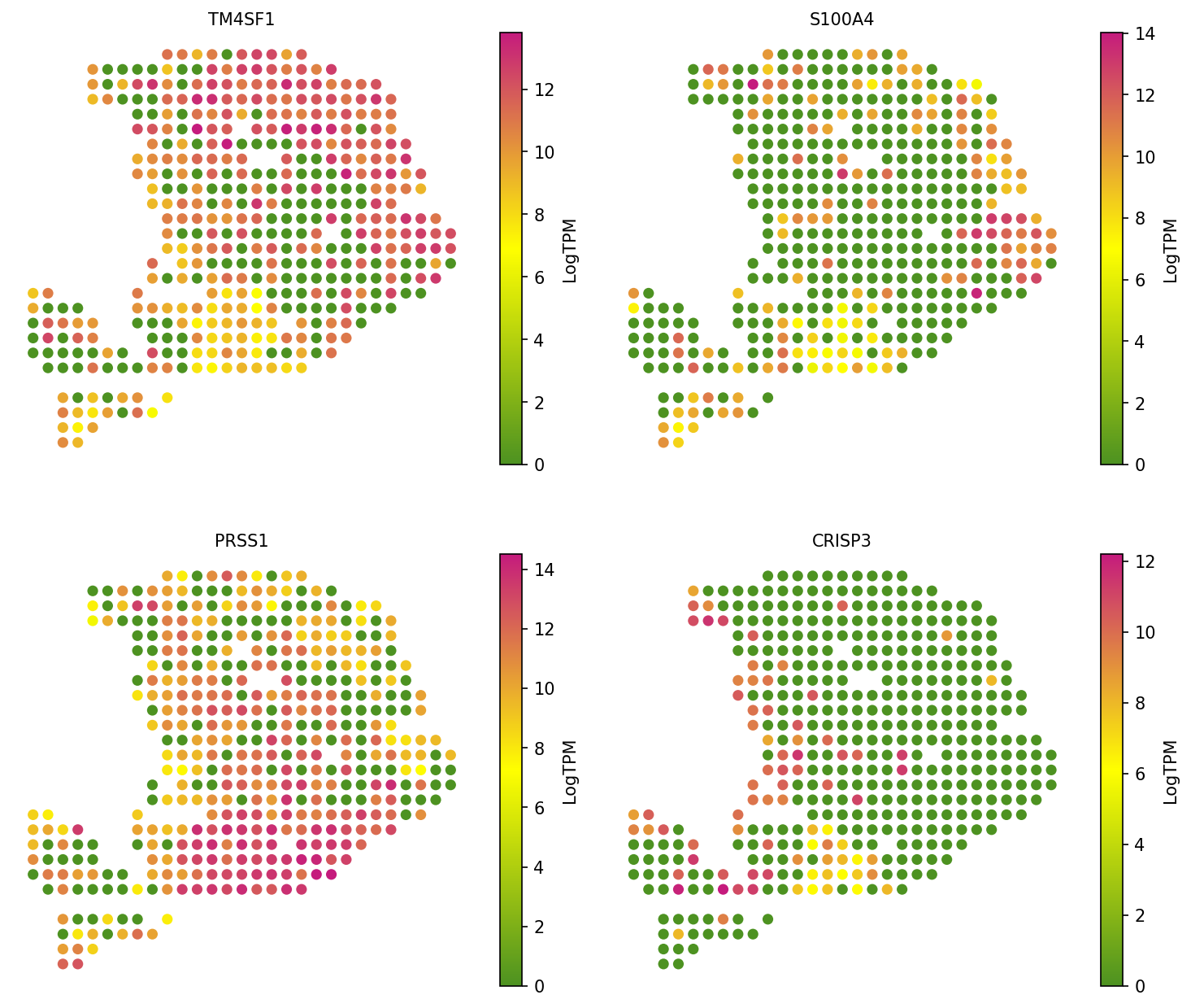 Marker gene expression in PDAC